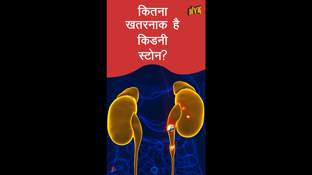 किडनी स्टोन का क्या कारण है *