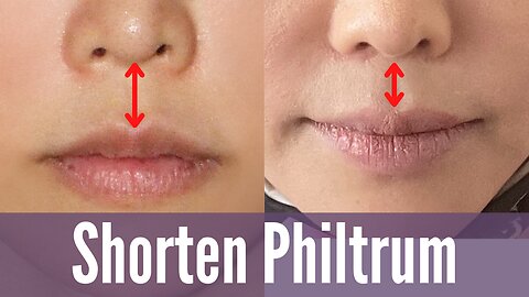 Shorten Philtrum