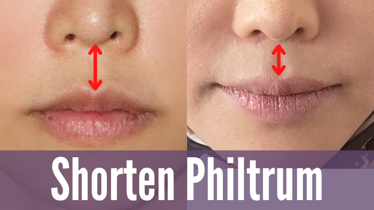 Shorten Philtrum