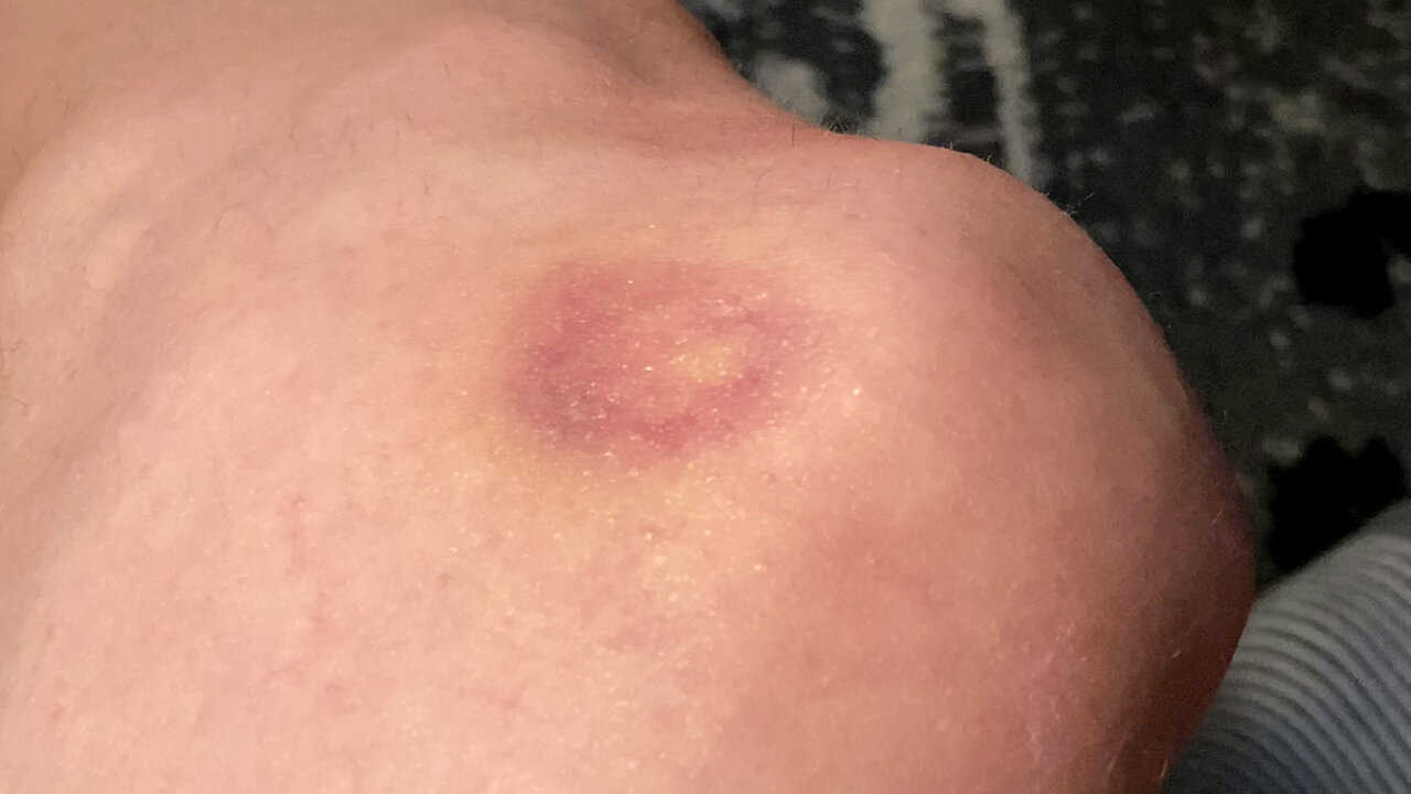 Weird Bruise Suddenly Appears | Weird Wednesday