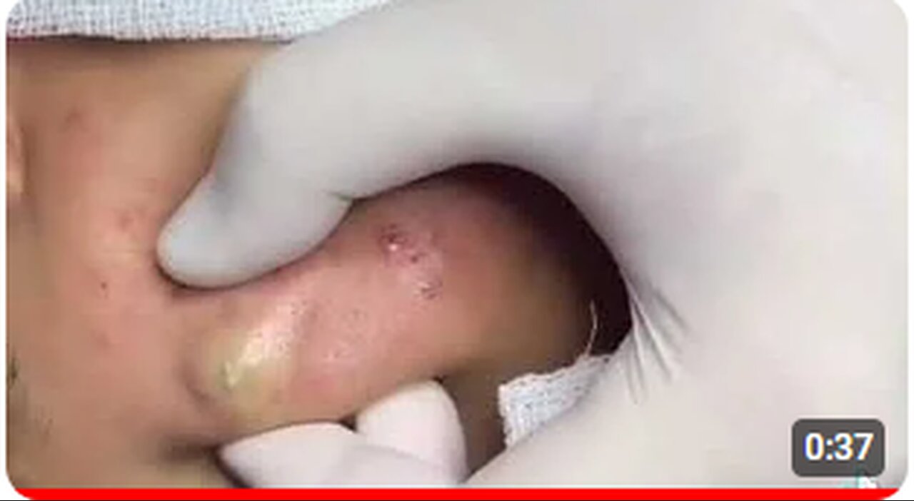 Deep Cystic Acne Extraction: Removing Blackheads, Milia, & Whiteheads - Pimple Popping Session- Pt 3