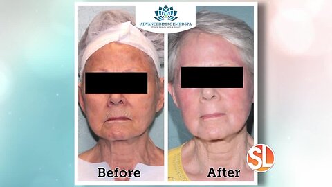 Look years younger with ONE treatment from Advanced Image Med Spa