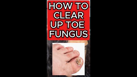 Toe fungus ⚠️