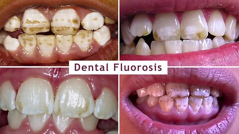 Human Health Risks from Fluoride Exposure