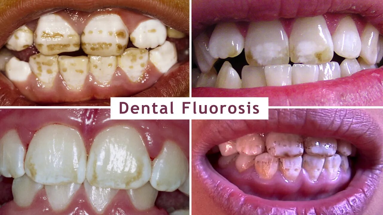 Human Health Risks from Fluoride Exposure