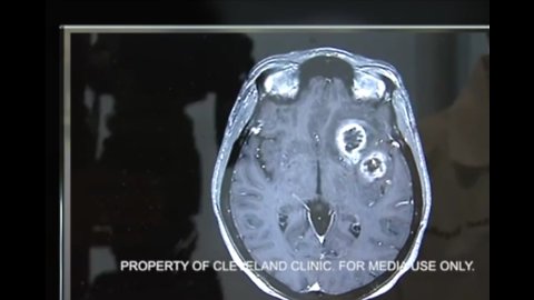 Pushing for more information on glioblastoma cases