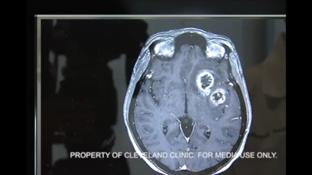 Pushing for more information on glioblastoma cases