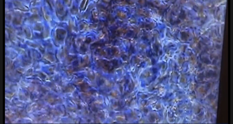 2回目ワクチン接種後、3週間目の血液。赤血球が離れず凝固