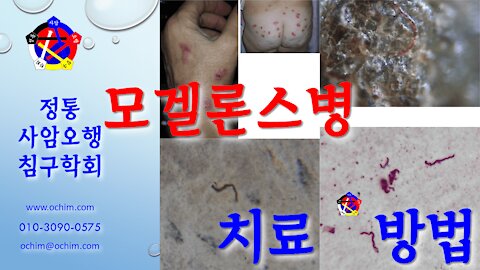 사암침, 사암침법 - 모겔론스병 치료 방법 - 비과학적 양의학 135