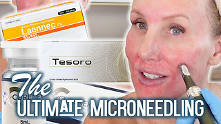 The Ultimate Microneedling Curenex + Laennec + Tesoro Fine 💕 Pro Tutorial