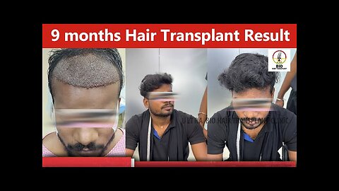 9 Months Hair Transplant Result