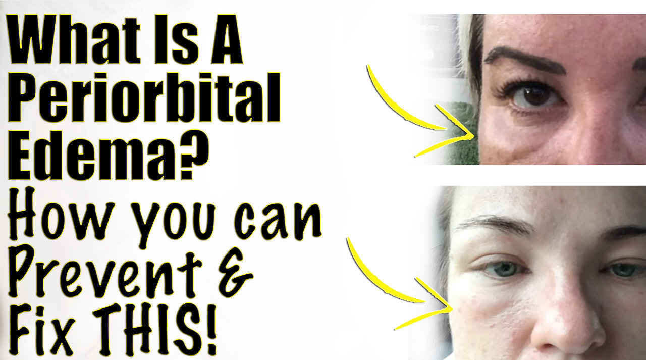 What is a PERIORBITAL Edema? How you can PREVENT and Fix This! Code Jessica10 Saves you Money