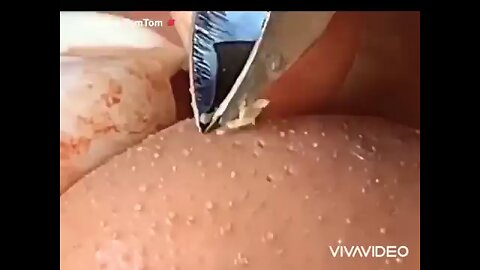 blackheads and acne removal 6 OMG😲😲😲