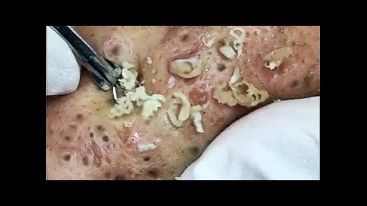 PimplePopper Blackheads Whiteheads Removal