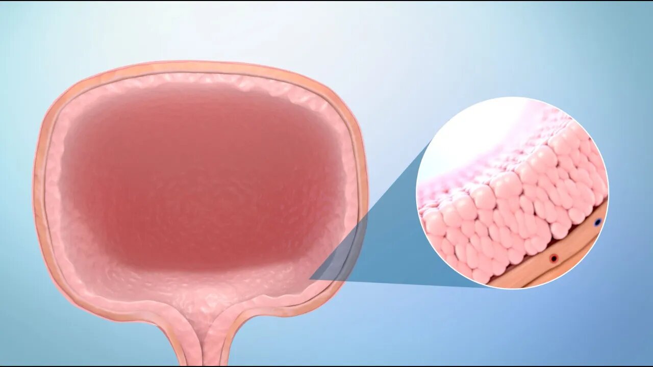 Opciones de tratamiento para el cáncer de vejiga