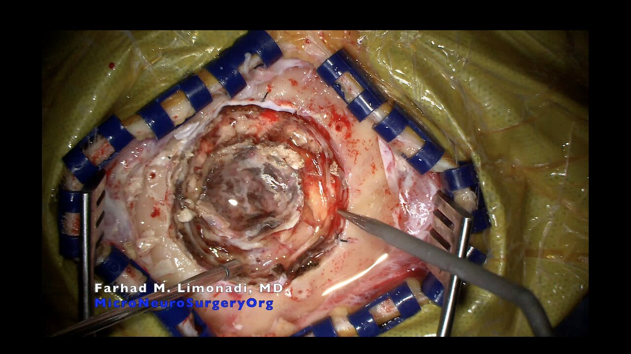 Parietal Craniotomy for Resection of Recurrent Glioblastoma (GBM). Continuation of the last case.