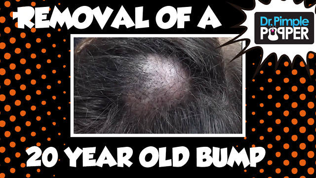 A 20-year old Embarrassing Bump on the Scalp: Dr Pimple Popper