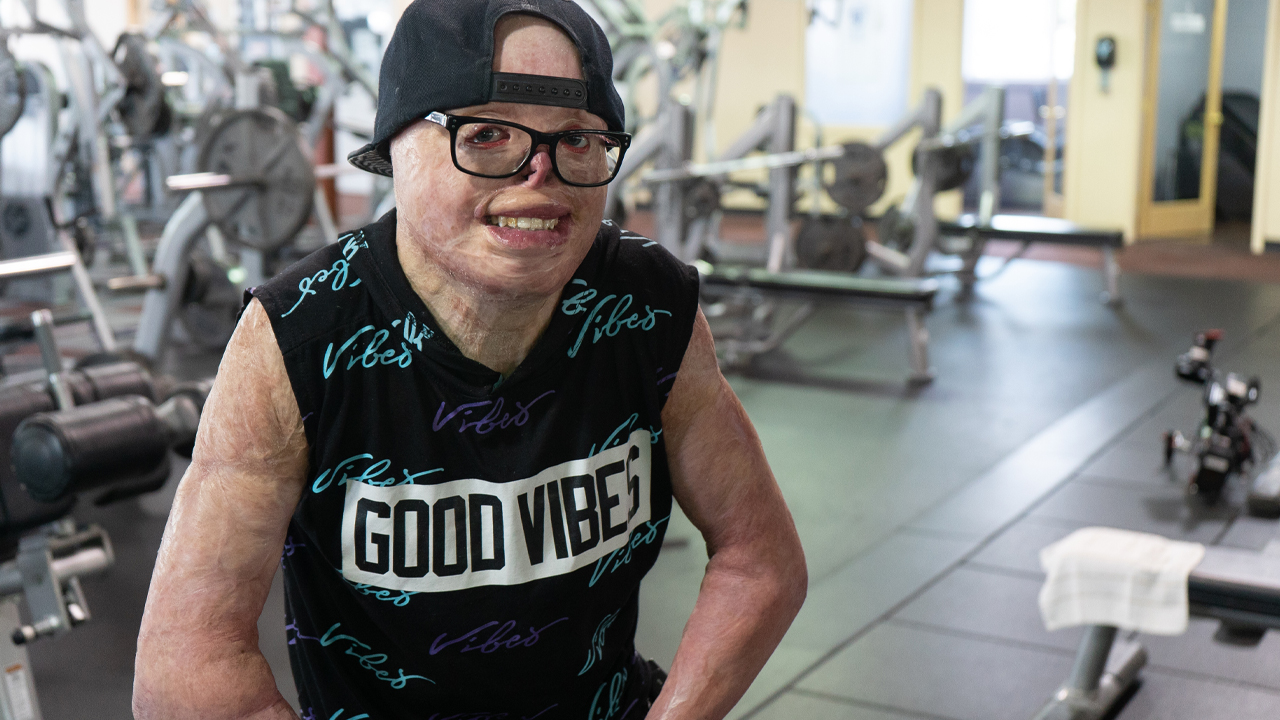 I Have 95% Burns - But I'm Thriving | SHAKE MY BEAUTY