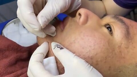 Ep6 whiteHeads extractions