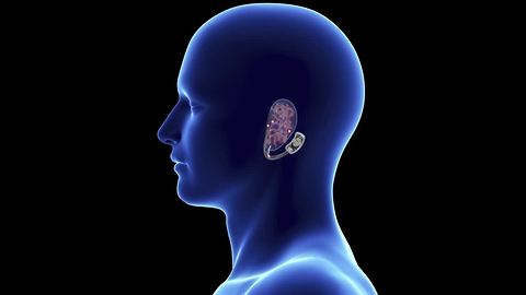 How it works: The Bridge is the first of its kind device to reduce symptoms of opioid withdrawal
