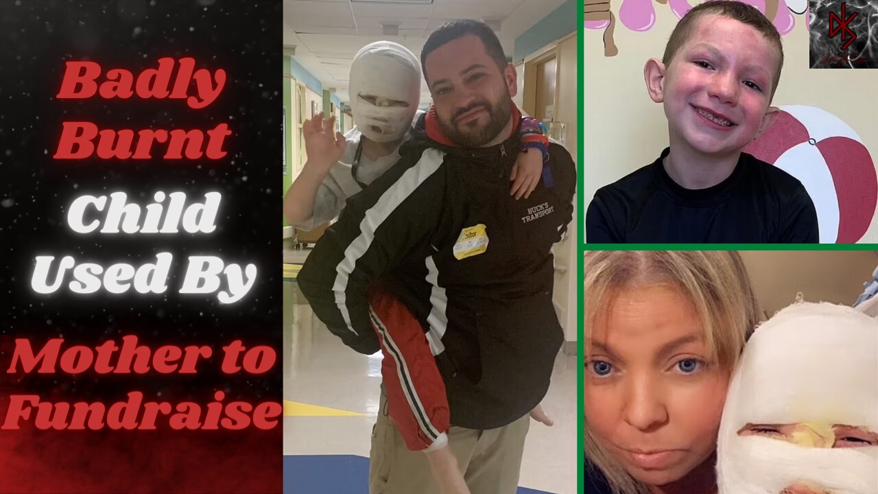 Mother of Horrifically Burnt Son, Lied About Neighborhood Kids to Raise $500,000!