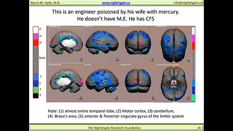 "Misdiagnosed" Mercury Poisoning [Chronic Fatigue Syndrome] Brain Injury case - Byron Hyde, MD