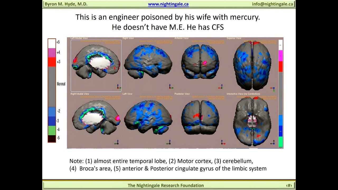 "Misdiagnosed" Mercury Poisoning [Chronic Fatigue Syndrome] Brain Injury case - Byron Hyde, MD