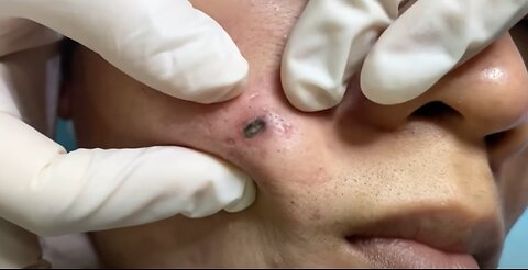 blackhead removal