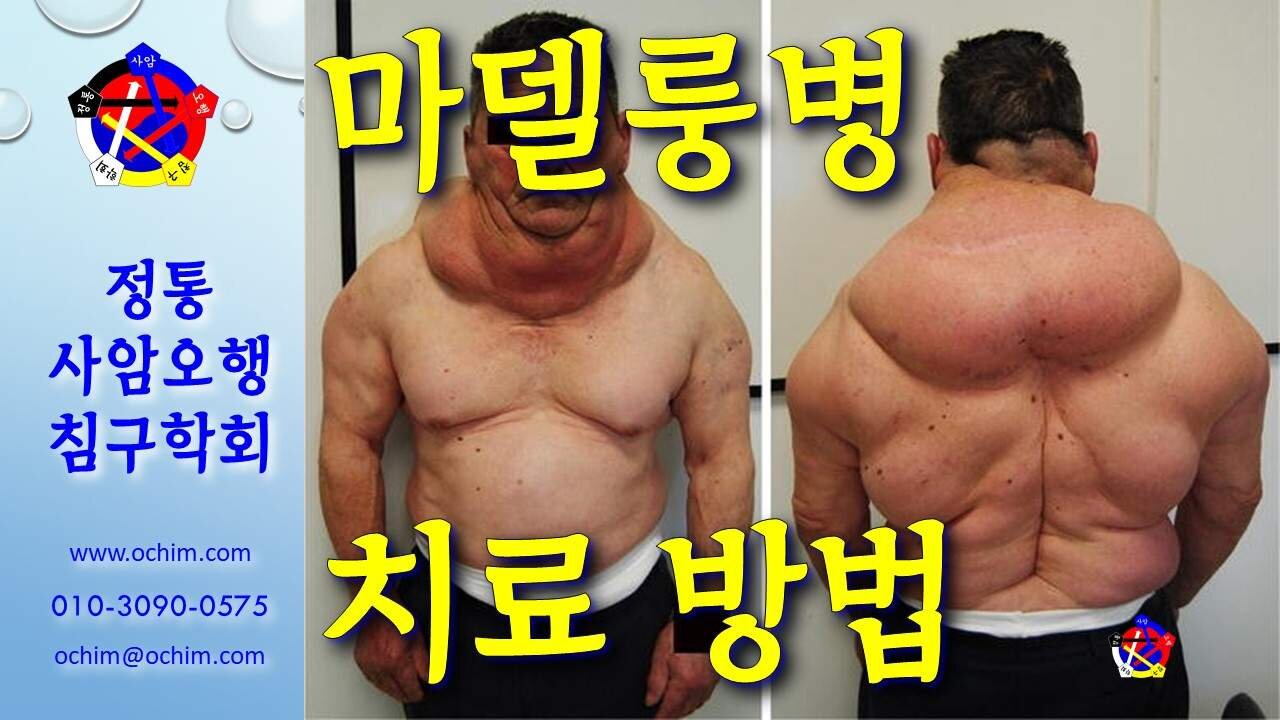 마델룽병 치료 방법 - 비과학적 양의학 154 - 사암침, 사암침법