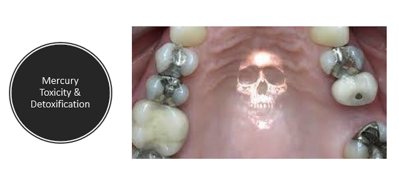 Mercury Amalgam Fillings - Detox