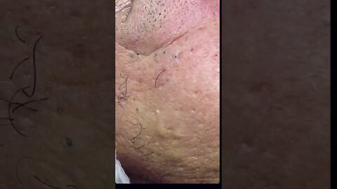 Remoção de Cravos e Espinhas - Remove Squeezing Blackheads and Pimples - Just Relax | Apenas Relaxe