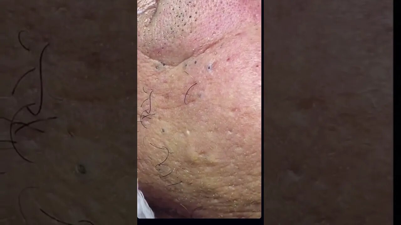 Remoção de Cravos e Espinhas - Remove Squeezing Blackheads and Pimples - Just Relax | Apenas Relaxe