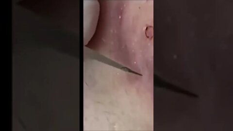 Pimple Popper tiktok popping.lover