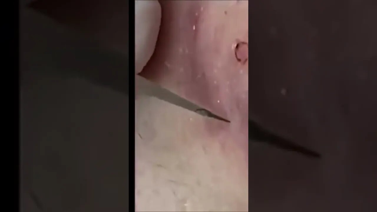 Pimple Popper tiktok popping.lover