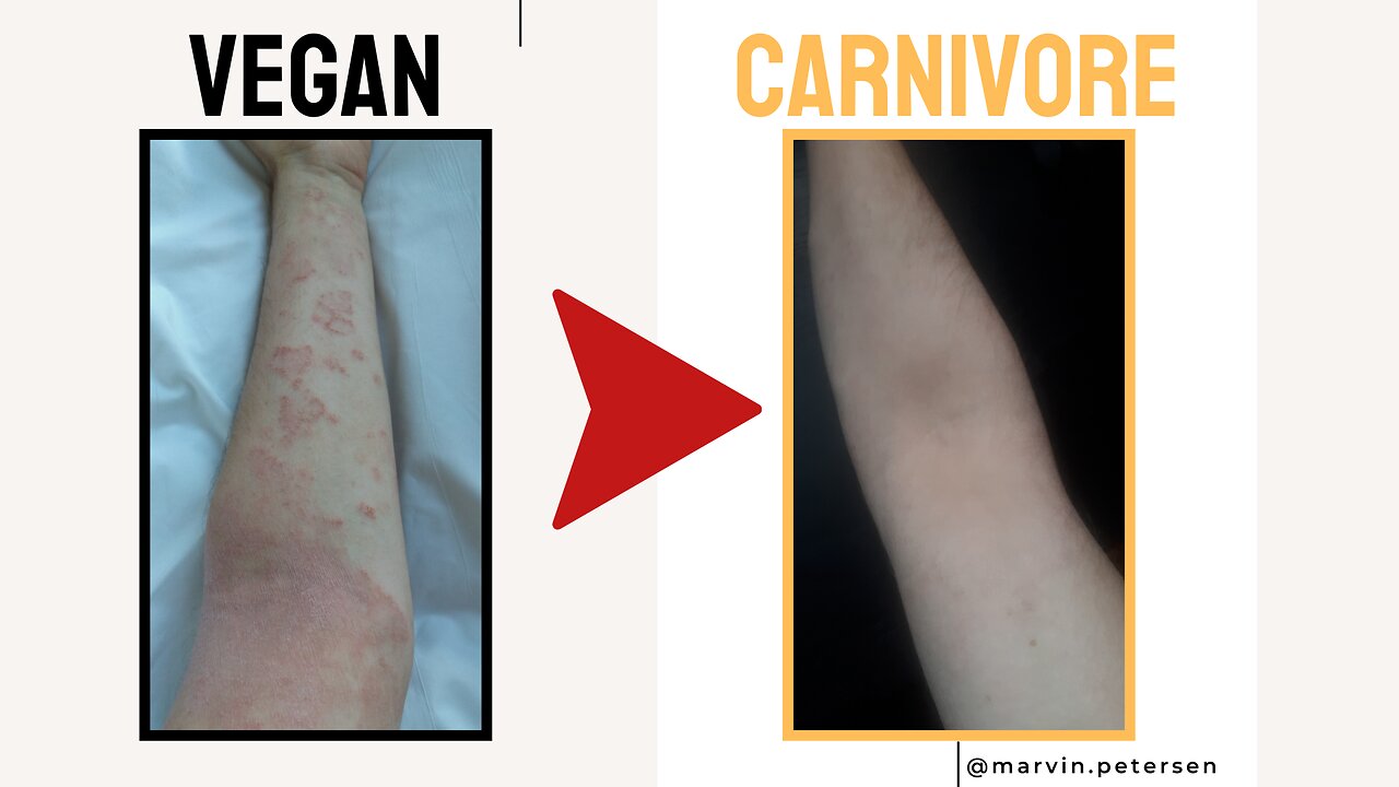 My Eczema Experience on the Vegan Diet (vs. Carnivore Diet)