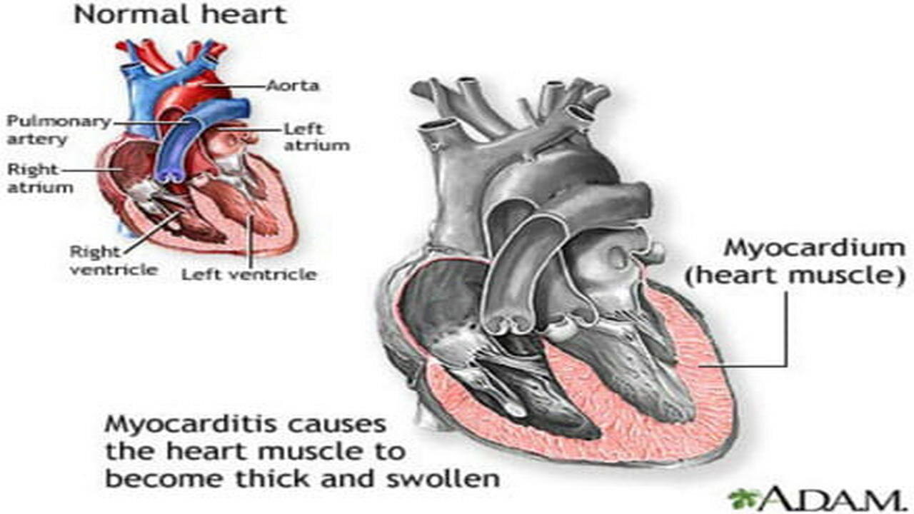 Normalising Myocarditis in kids!