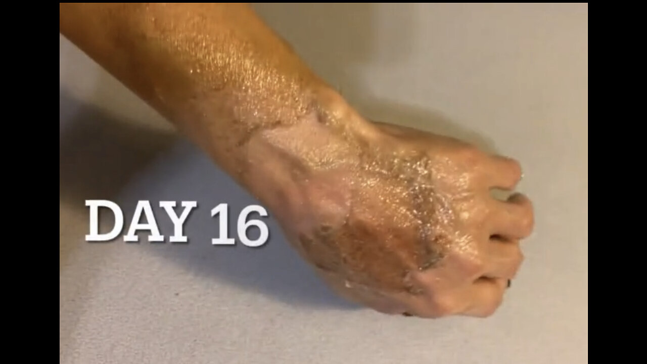 TCA Chemical Peel Dried Hand