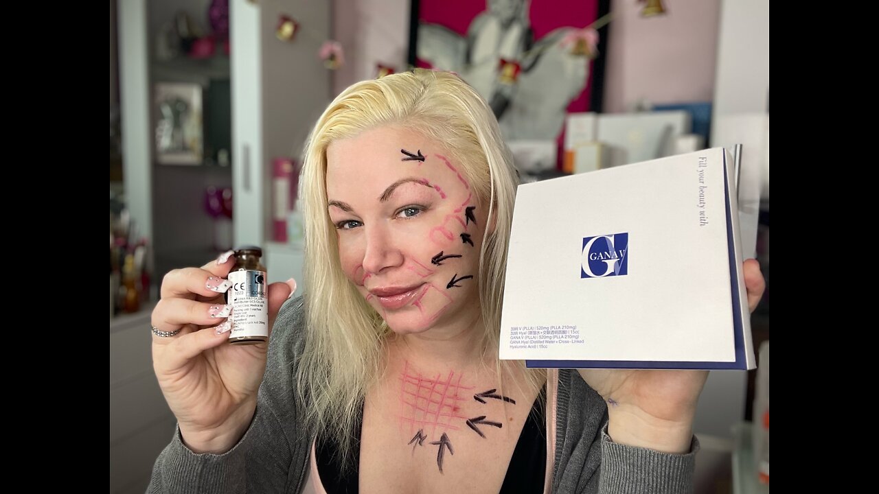 Better then Sculptra using GANA V in Temples, Nasolabial folds and cheeks! Code Jessica10 save $
