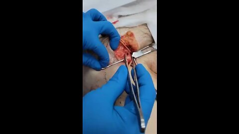 Vaxxed Person on Operating Table