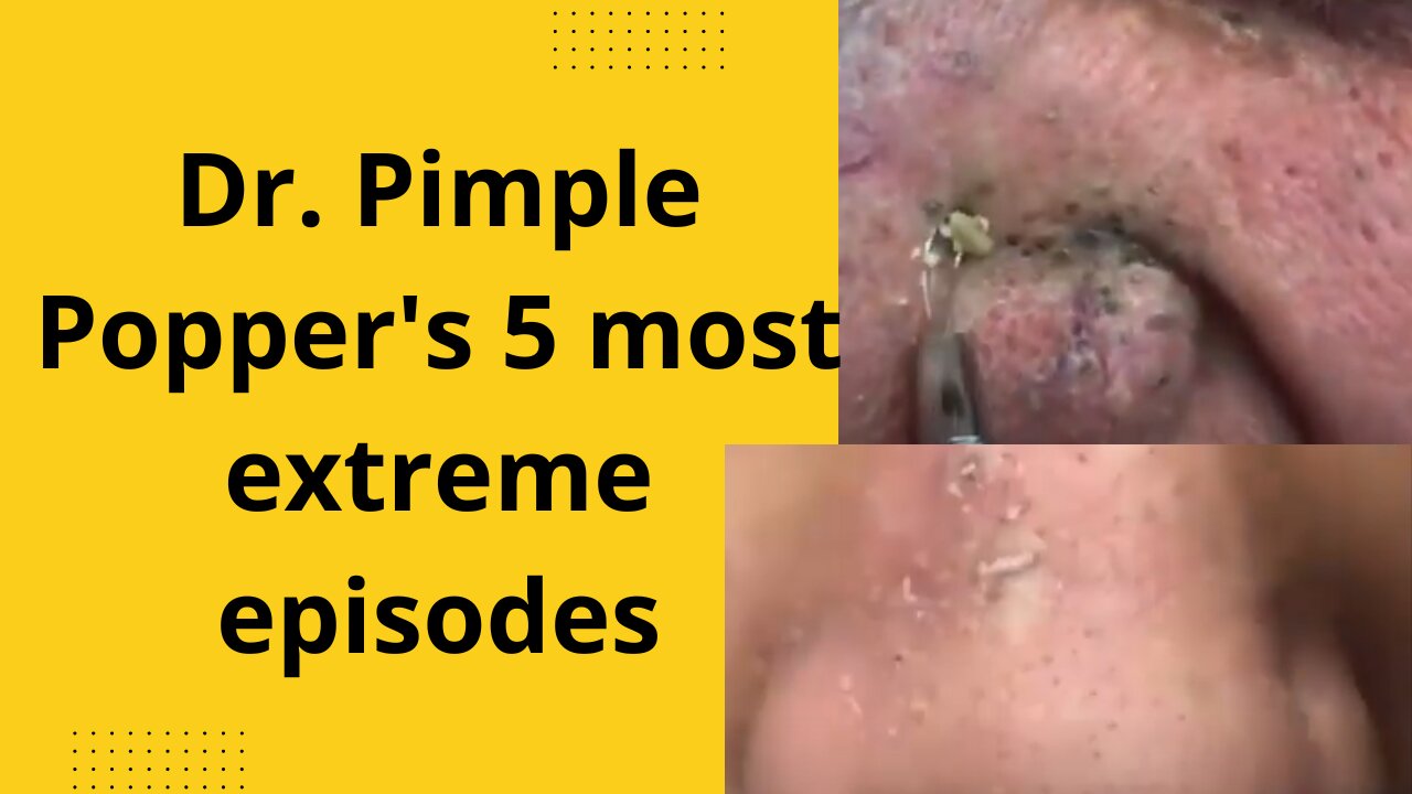 dr pimple popper blackhead extraction pops whiteheads whiteheads #pimple