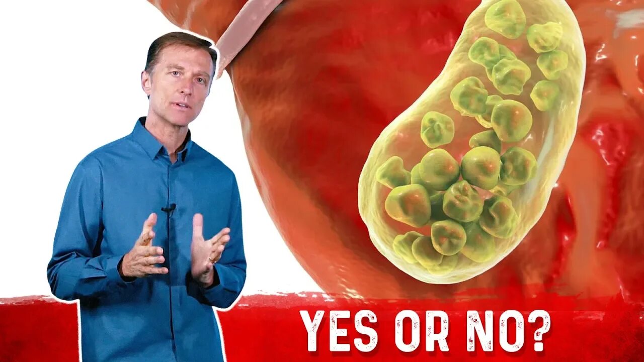 Do Gallstones Come From High Cholesterol? – Dr.Berg