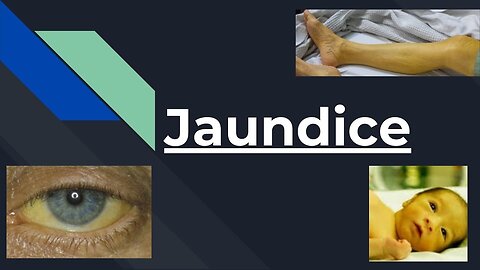 JAUNDICE ( TYPES, LAB TESTS, DIAGNOSIS, TREATMENT, INTERPRETATION) | Novice Medic
