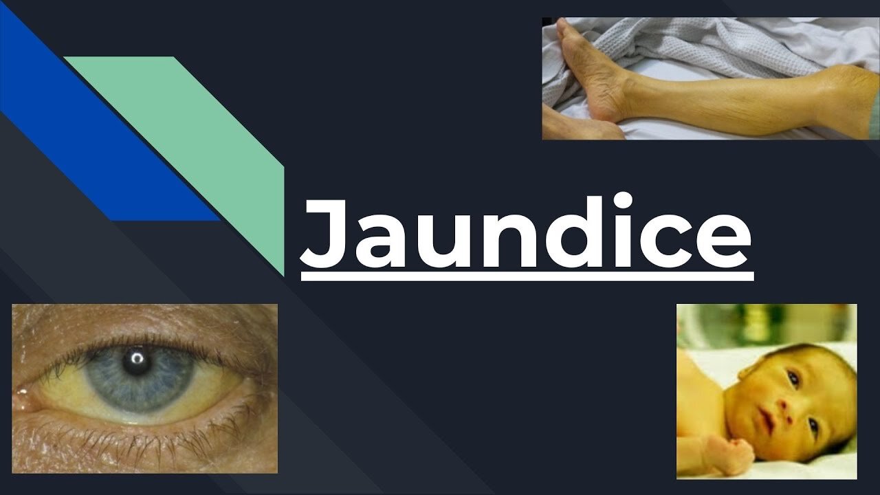 JAUNDICE ( TYPES, LAB TESTS, DIAGNOSIS, TREATMENT, INTERPRETATION) | Novice Medic