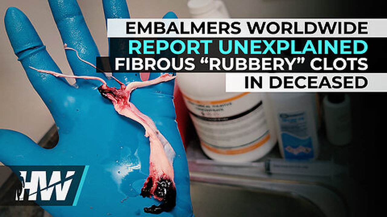 EMBALMERS WORLDWIDE REPORT UNEXPLAINED FIBROUS “RUBBERY” CLOTS IN DECEASED 2/24/24