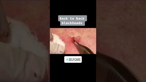 Multiple Blackheads on the Back - Blackheads removal