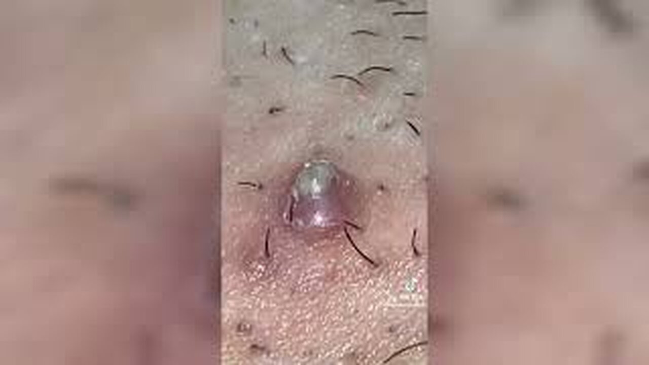 Satisfying Pimple Popping Splinter Blackhead Removing Tiktok compilation 1