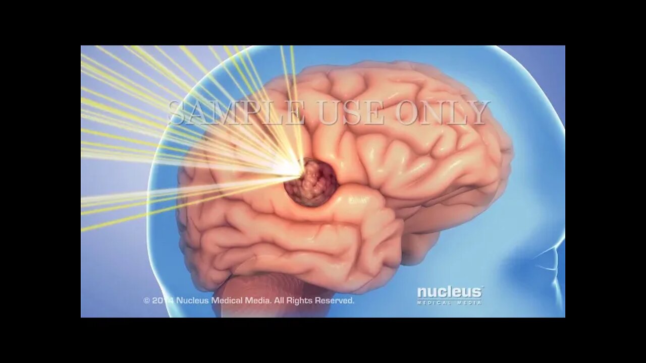 Gamma Knife® (radiocirugía estereotáctica)
