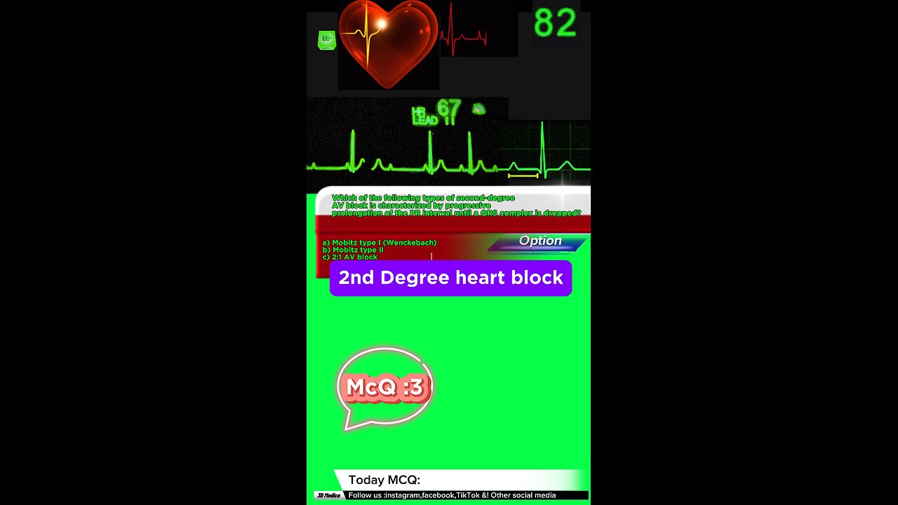 Second degree heart blockages #2nddegreeheartblock #arrthymias #CardiacArrhythmia