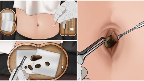 ASMR | Remove Huge Navel Stone Animation #ASMR #Treatment #navel