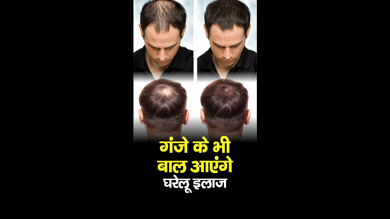 "गंजेपन का समाधान: बालों की पूरी तरह से बढ़ने का आविष्कार"